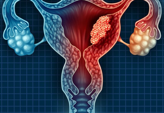 Cervical Cancer Treatment