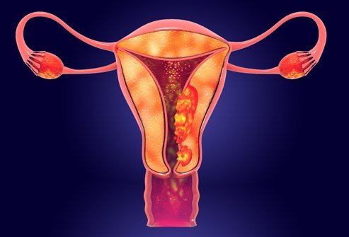 Uterine Cancer Treatment