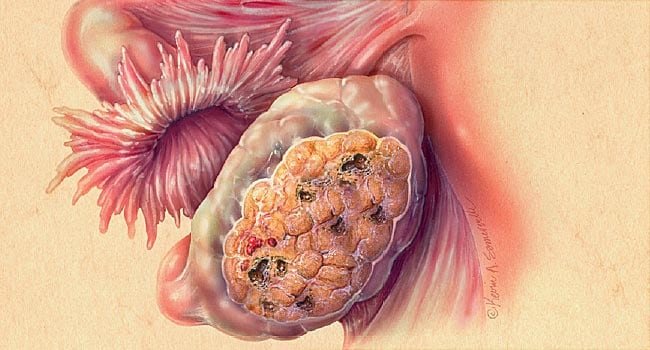 Ovarian Carcinoma Treatment